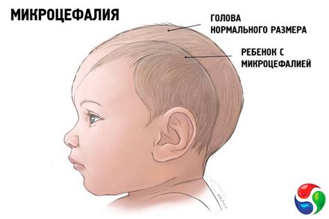 Microcephaly: causes, symptoms, diagnosis, treatment