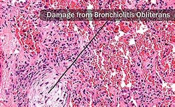 Popcorn Lung – Causes, Symptoms, Diagnosis, and Treatment