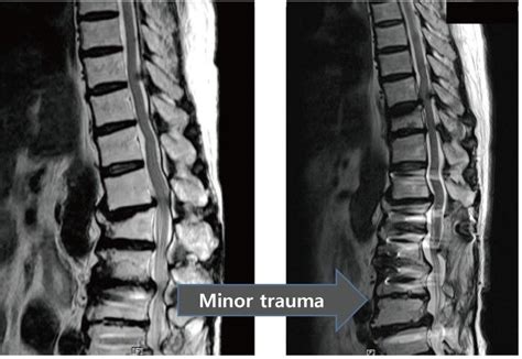 T10-11 ossification of the ligamentum coexisting with traumatic ...