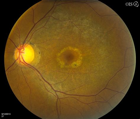 Bull's Eye Maculopathy Without Plaquinel - Retina Image Bank