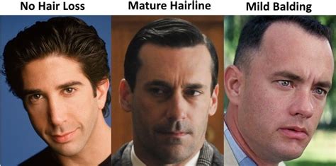 The Mature Hairline Explained – Are You Balding or Maturing ...