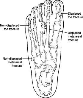 Fracture-toe - North Suburban Foot and Ankle Center