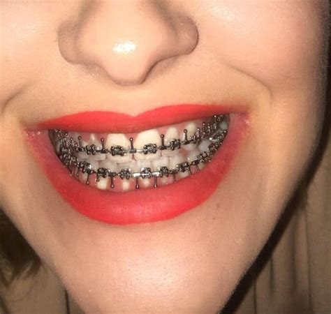 Pin de Edgepsp en Braces girls | Brackets dentales, Ortodoncia brackets ...