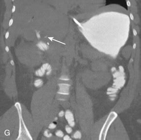 Computed Tomography Enteroclysis | Radiology Key