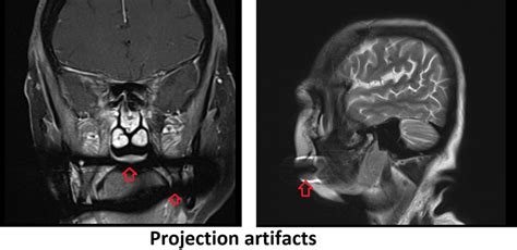 MRI projection artifact | Braces mri artifact | Titanium mri artifact