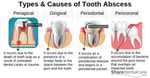 Tooth Abscess Treatment: Relief from Pain & Infection - Share Dental Care