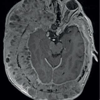 3.0 T MRI with and without administration of paramagnetic contrast ...