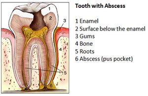 Home Remedies For An Abscessed Tooth? - Dentista Italiano a Londra