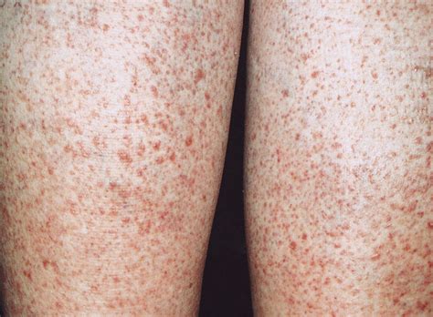 10 Dermatologic Signs of Celiac Disease - Dermatology Advisor