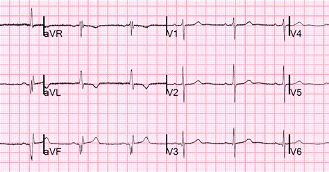 Dr. Smith's ECG Blog: Coronary Disease and Chest pain: Is it acute inferior OMI or old inferior MI?