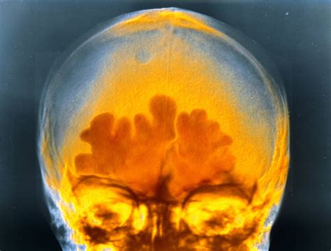 This is what the inflammation of sinus infection looks like in a false ...