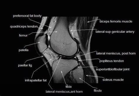 MRI anatomy of the knee | Knee mri, Mri, Knee doctor