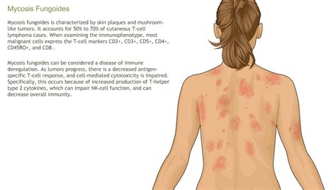 B Symptoms Of Hodgkin's Lymphoma