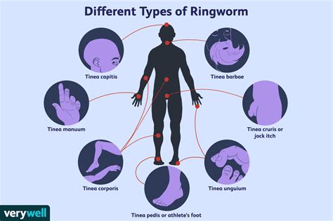 Ringworm: Overview and More