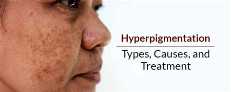 Hyperpigmentation: Types, causes, and treatment – Fixderma Skincare