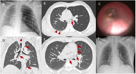 (A) Initial chest X-ray showing signs of left lung hyperinflation with... | Download Scientific ...