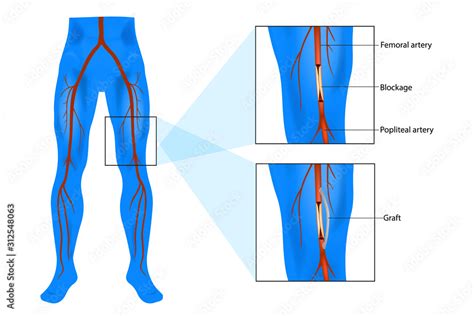 Femoral popliteal (also called femoropopliteal or Fem-Pop) bypass surgery. Graft bypass. vector ...