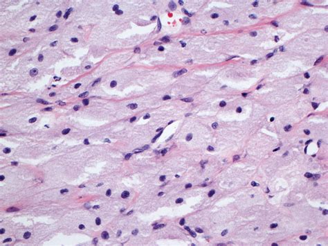 Epulis Histology