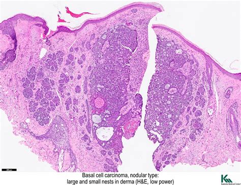 Basal Cell Carcinoma Skin Histology