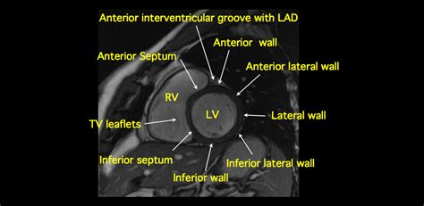 MRI BLOG: Cardiac Anatomy