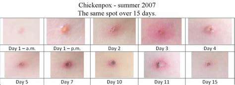 Hives vs chicken pox - BabyCenter