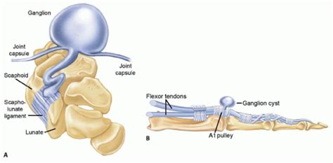 Ganglion Cyst Diagram