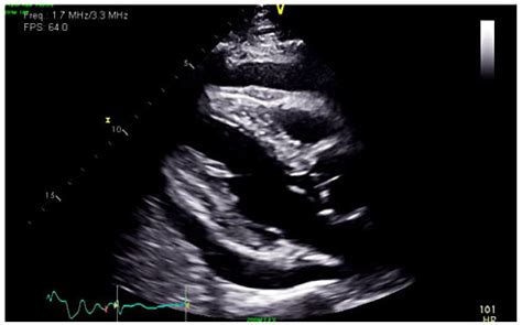 Parasternal long-axis view of pericardial effusion on echocardiogram ...