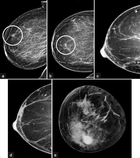 A fifty-two-year-old woman with developing focal asymme | Open-i