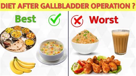 Diet after Gall Bladder Removal Surgery | What to Eat | पित्त की थैली ...