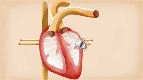 Aultman Performs First Watchman Heart Procedure » Aultman