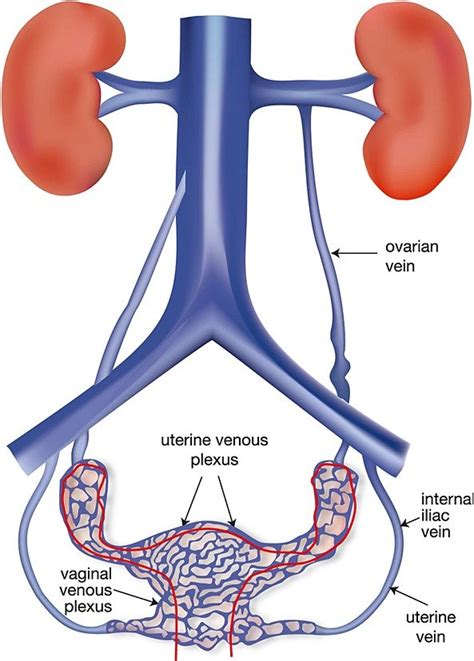 Ovarian Vein Embolization/Stenting