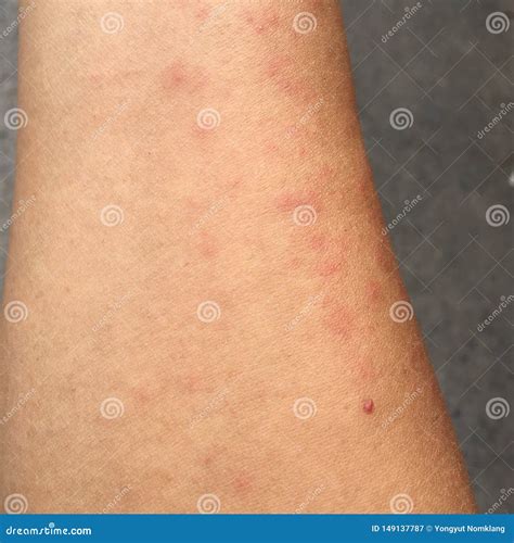 Rash Caused by Skin Allergic To Sweat, Dust and Viruses. Stock Image ...