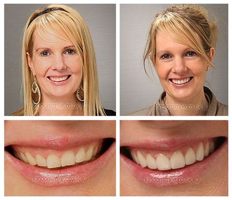 How To Fix A Gummy Smile Uk : Dr Teri Describes How She Treats Gummy Smiles With Botox In ...