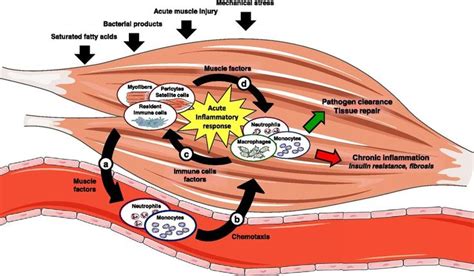 What is Myositis? - Myositis Support and Understanding