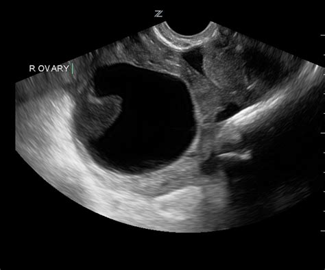 Hemorrhagic ovarian cyst with retracting clot. | Download Scientific Diagram