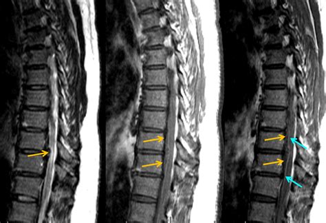 Infarction: Anterior Spinal Artery Infarction