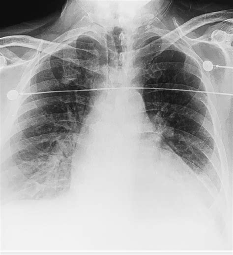 Chest X-ray demonstrating bilateral pulmonary edema and cardiomegaly... | Download Scientific ...