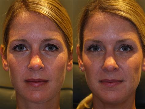 Denver - BOTOX Brow Lift - Photos Show Results Without Surgery