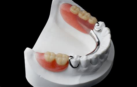 Cast Partial Denture - Atlas Dental Toronto