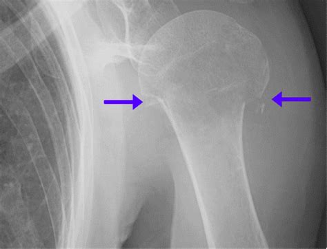 Humeral Neck Fracture: Orthopedic Teaching: Feinberg School of Medicine ...