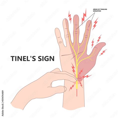 Tinel’s and phalen's sign test for carpal tunnel syndrome compressed hand with Guyon's canal ...