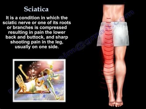 Best Treatments | Sciatica Symptoms 2022 | Dr Vipin Garg KLM GROUP 2022