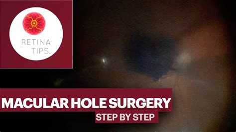 Macular Hole Surgery Step by Step - YouTube