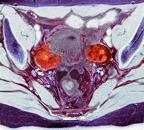 Ovarian cancer, MRI scan - Stock Image - C050/9705 - Science Photo Library