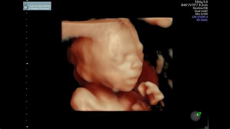 Baby Ultrasound Pictures 20 Weeks - Baby Viewer