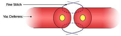 ivf-infertility.com | Vasectomy reversal