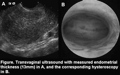 Thickened endometrial stripe in women with post-menopausal bleeding: an association with a ...