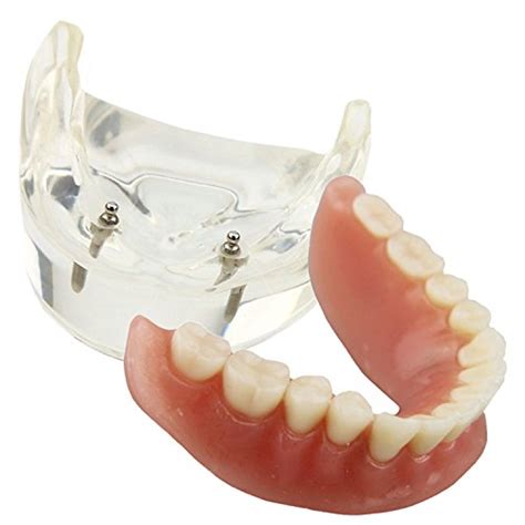 Best O-Rings For Dental Implants: A Comprehensive Guide