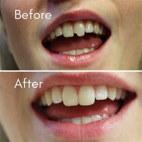 Broken Teeth |Chipped Teeth | Cracked Tooth Repair | General Dentistry