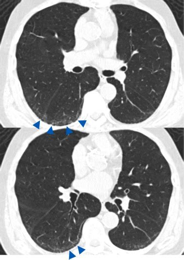 Traction Bronchiectasis/Bronchiolectasis is Associated with Interstitial Lung Abnormality ...